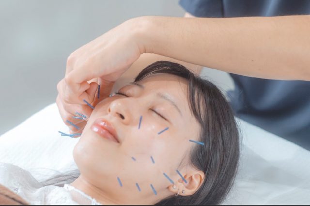 美容鍼